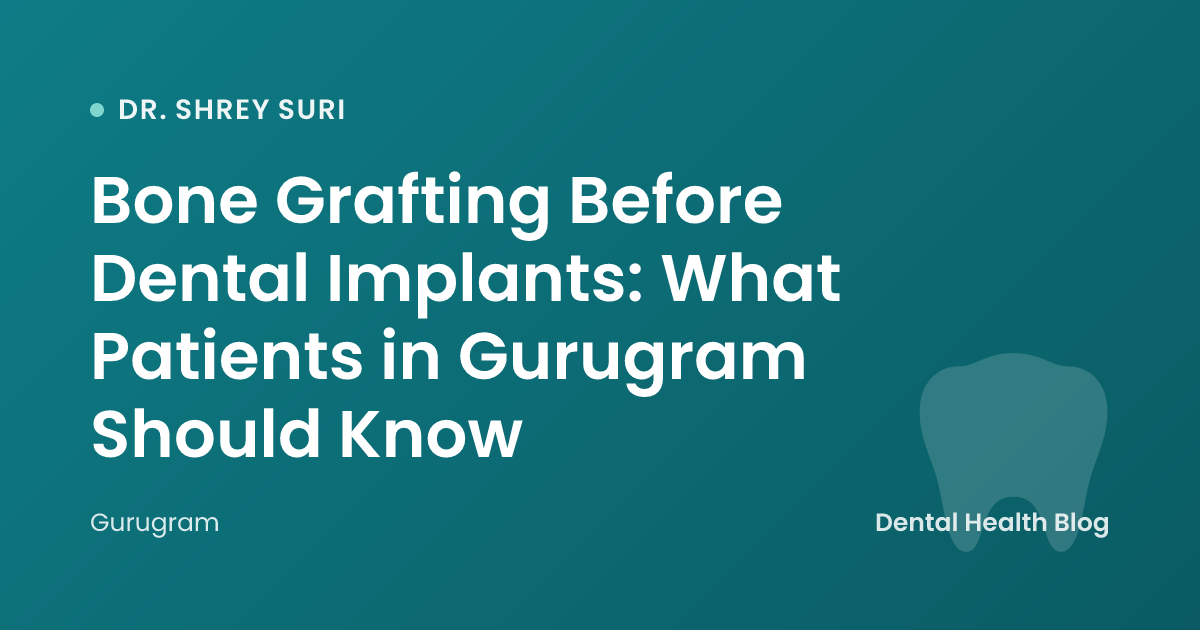 Bone Grafting Before Dental Implants: What Patients in Gurugram Should Know