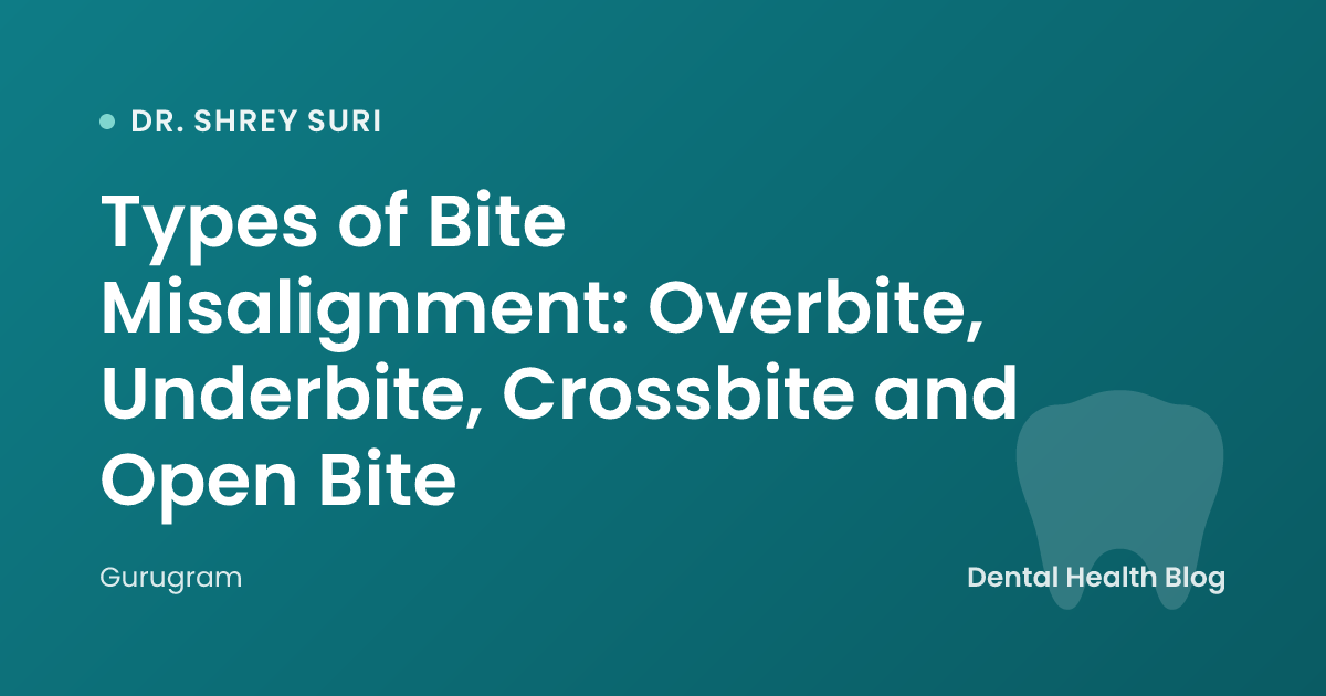 Types of Bite Misalignment: Overbite, Underbite, Crossbite and Open Bite