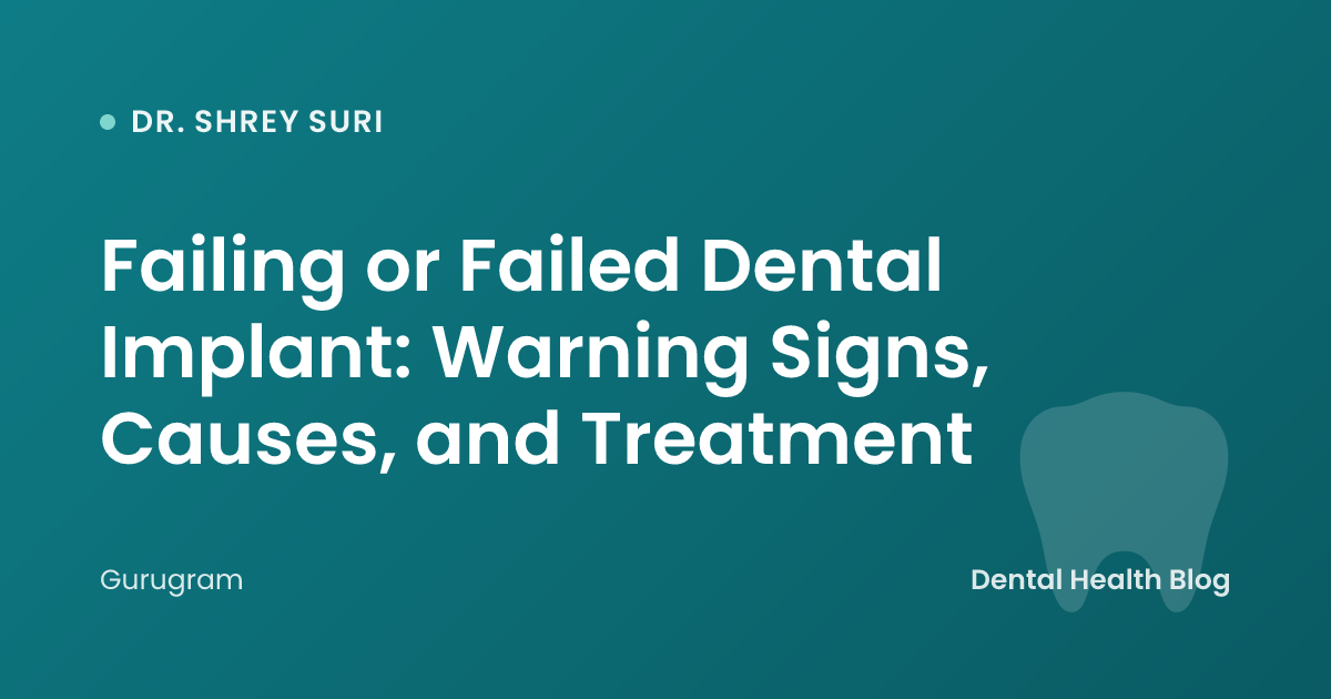 Failing or Failed Dental Implant: Warning Signs, Causes, and Treatment