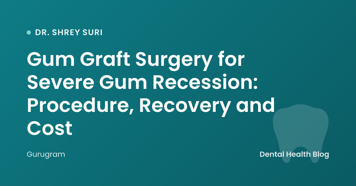 Gum Graft Surgery for Severe Gum Recession: Procedure, Recovery and Cost