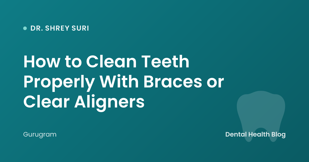 How to Clean Teeth Properly With Braces or Clear Aligners