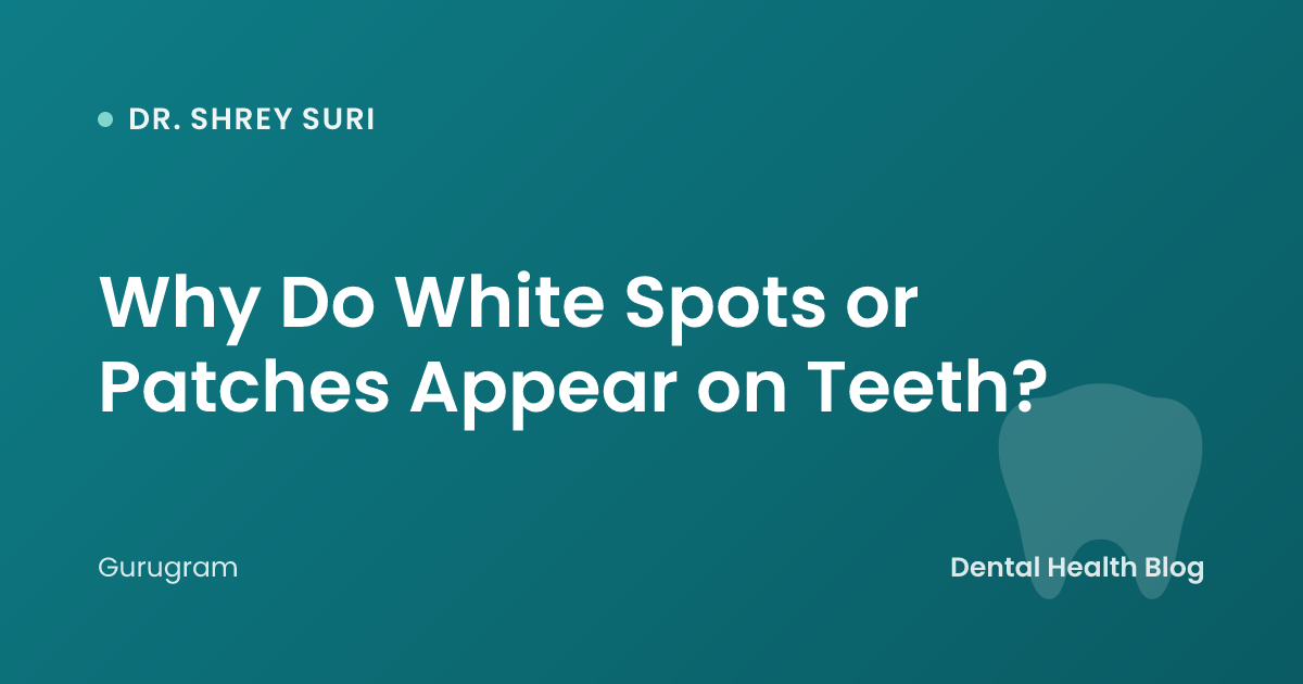 Why Do White Spots or Patches Appear on Teeth?